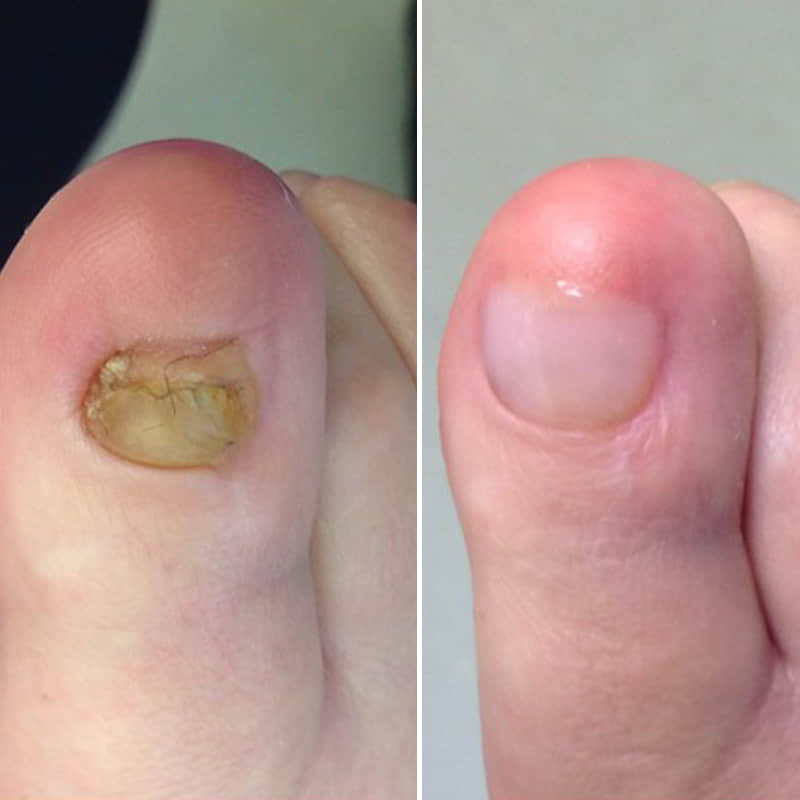 Before and after nail treatment