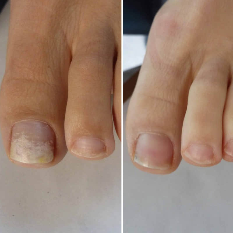 Before and after nail treatment