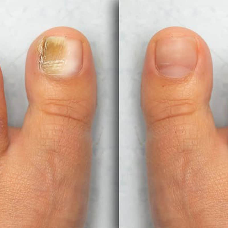 Before and after nail treatment